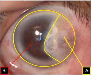 The parameter of pterygium size measured by MatLab™ software. Each area of entire cornea (B) was measured and the area of pterygium on cornea (A) was also measured and then the CPTA was defined as the ratio (A/B×100) calculating the proportion of pterygium invading onto the cornea.