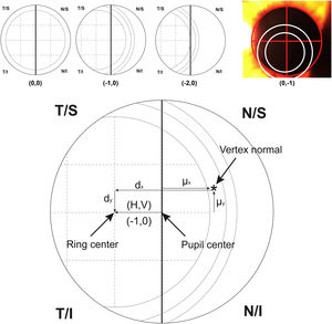 Top image shows an example of the ordinal scale used for evaluating the intraocular lens centration. The diagram describes the right eye with the pupil divided by a vertical line. The first ring of the lens is divided in 4 sections that serve as a reference to measure the displacement to the pupil center. From left to right, the lens is centered (0.0), 25% temporal (−1.0) and 50% temporal (−2.0) the size of the first ring. The last top image shows a real example with pupil divided by a red cross and rings of the lens marked with white circles for a clear visualization. For vertical centration, the same approach was performed dividing the pupil by a horizontal line. Bottom image shows the system of coordinates used in the research (For interpretation of the references to colour in this figure legend, the reader is referred to the web version of this article).