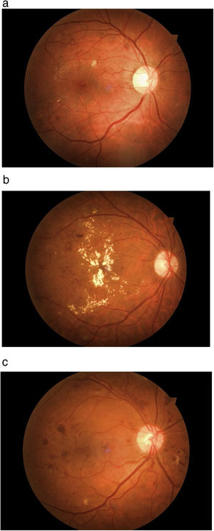 Fundus photography (right eye) of a patient with background diabetic retinopathy. This patient needs regular monitoring and good control of diabetes. (b) Fundus photography of the right eye of a diabetic patient with severe diabetic maculopathy with multiple hard exudates that should be referred for further assessment and management by a medical retina specialist. (c) Fundus photography (right eye) of a patient with diabetic macular oedema, cotton wool spots and retinal hemorrhages. This is a case of a moderate to severe non-proliferative diabetic retinopathy that calls for treatment with panretinal laser photocoagulation and intravitreal injections with anti-VEGF (Vascular Endothelial Growth Factor) agents.