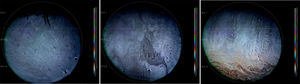 Stroboscopic video color microscope (SVCM) images taken from an individual subject who best represented average LLT at baseline and 15min post-instillation of the emollient and non-emollient eye drops in the lower LLT (<50nm) cohort. (A) Baseline image taken prior to drop instillation. (B) Image taken 15min following instillation of the non-emollient eye drop. (C) Image taken 15min following instillation of the nanoemulsion eye drop. The brighter colors correspond to a thicker lipid layer as depicted on the key to the right of each image.