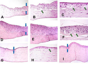 Histopathology preparation of H&E stained penetrating keratoplasty specimens of patients with keratoconus. Distinctive patterns of epithelial alteration of the central cornea.a)Increased central corneal epithelial thickness (blue arrows) with hypertrophy and pronounced hydropic changes. Original magnification 20×.b)Increased central corneal epithelial thickness (green arrow) with hypertrophy and pronounced hydropic changes. Original magnification 40×.c)Pronounced hydropic changes (green arrows) in the central corneal epithelium in keratoconus. Original magnification 63×.d)Increased central corneal epithelial thickness with marked hyperplasia of the epithelium (blue arrows). Original magnification 20×.e)Marked hyperplasia of the central corneal epithelium. Original magnification 40×.f)Focal hydropic changes with partial epithelial detachment in the central corneal epithelium (green arrows). Original magnification 63×.g)Patient with advanced keratoconus with unchanged central epithelial thickness (blue arrows). Original magnification 20×.h)Markedly reduced central epithelial thickness with atrophy (blue arrows). Original magnification 20×.i)Markedly reduced central epithelial thickness with atrophy and focal cell swelling (green arrow). Original magnification 63×.