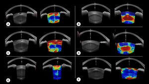 Examples of our model's results. For each case, the original image is on the left, and the model results overlayed on the original image is on the right. Hot colors indicate a high probability of cataract. A and C are cases of cortical cataracts. B and D of nuclear cataracts. E is a case of anterior cortical cataract and F is a case of cortical and posterior subcapsular cataract.