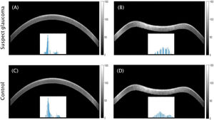 Corneal Scheimpflug images after segmentation (i.e. without background) of a randomly chosen suspect glaucoma participant (A, B) and a randomly chosen control participant (C, D); before air-puff (A, C) and during air-puff (B, D). Colour bars indicate pixel intensity. Scaled histograms corresponding to corneal pixels are shown for each image.