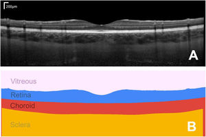 Example foveal-centred spectral domain (SD) OCT scan of the posterior segment of the eye of a healthy subject, showing a cross-section of the retinal and choroidal tissue (A) and its corresponding segmented regions of interest, from which quantitative measures of tissue layer thickness can be derived (B). Bar in top right of A shows the scale.