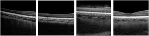 Example OCT scans: three of which are generated by a GAN while one is real. We encourage the reader to discern which image is the real one (answer can be found in the Conclusion section).