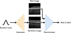 Overview of a generative adversarial network (GAN) for generating cross-sectional retinal OCT images. The generator takes a random noise vector as input and produces a synthetic image. The discriminator is required to distinguish between the synthetic (fake) images (created by the generator) and the real images.