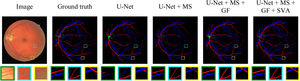 Artery-Vein classification maps of different modules for retinal fundus images from AV-DRIVE dataset. Three regions are enlarged in the second row. Artery and vein pixels are labelled with red and blue colours, respectively. Module components are added from left to right with baseline U-Net.