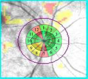 Superimposition of the clock-hour map onto the fundus photography of the optic nerve with Cirrus-HD. We observe the presence of blood vessels at clock-hour 1, 7, 8, 9 and 11 in a patient diagnosed with glaucoma.