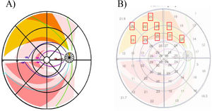 Adaptation of the clock-hour map to the mathematical retina model of Jansonius (2009). It is observed how each nerve fiber bundle trajectory in the human retina matches to the corresponding individual clock-hour sector of the ONH (the whole 12 clock-hours). An example is shown of the correspondence made in the right eye between the trajectory of the bundle axons along the retina according to Jansonius (indicated in yellow) and its corresponding input region (clock-hour 1 in yellow) in the ONH.