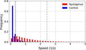 Normalized histogram of frequencies for the speed of eye movements in patients with nystagmus and the control group. The vertical lines indicate the percentile 85 of each group, dashed line for nystagmus and dotted line for the control group.