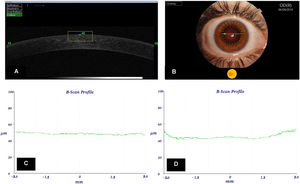 3D OCT Maestro-1 corneal images showing corneal epithelium, Bowman's layer, and endothelium (A) with meridian selector application (B). Graphs were automatically performed and represents the epithelial thickness (microns) for the 6 mm chord corneal area before Ortho-k lens wear (C) and during treatment (D).