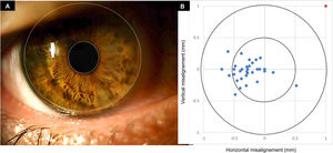 Misalignment in a representative patient capture (A). Diagram showing Ortho-k lens decentration relative to pupil centre for the whole sample (B). Note the temporal decentration pattern.