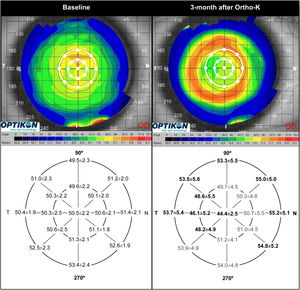 Corneal topography and epithelial thickness changes between baseline (left) and after 3-month Ortho-k treatment period (right). Data of corneal location showing significant differences (p<0.05) appear in bold. Note the stronger central and temporal epithelial thinning, and highest mid-peripheral thickening corresponding to nasal area in clear association with temporal decentration observed in this study.