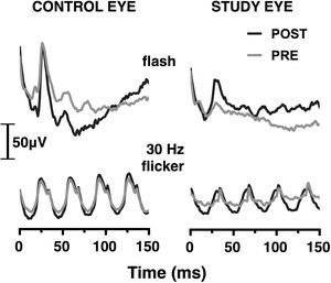 Grand-averaged (N = 9) full-field light-evoked ERG waveforms for the control (left) and study (right) eyes in photopic flash (upper) and photopic flicker (lower) conditions: pre (grey lines) and post (black lines) silicone oil removal (SOR) surgery.