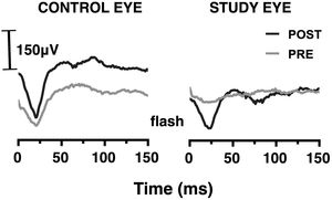 Grand-averaged (N = 9) full-field light-evoked ERG waveforms for the control (left) and study (right) eyes in the scotopic flash condition: pre (grey lines) and post (black lines) silicone oil removal (SOR) surgery.