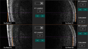 Four spikes of the crystalline lens components. The differences in readings between the spikes indicate the following lens components: A1 and B1 spikes (lens thickness), A1 and A2 spikes (anterior cortex thickness), B1 and B2 spikes (posterior cortex thickness), and A2 and B2 spikes (lens nucleus thickness).