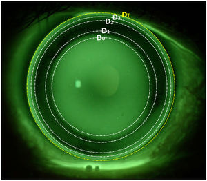 Sodium fluorescein image of a large diameter rigid gas-permeable corneal CL for keratoconus. The white rings correspond to the different zone changes (D0, D1, D2 and D3), and the yellow ring shows the total lens diameter (DT).