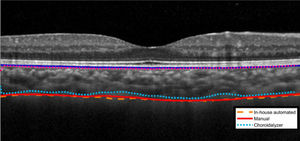 A representative OCT scan showing the three segmentation methods, manual (solid red), in-house automated (dashed-yellow) and open-source automated (Choroidalyzer, dotted sky blue).