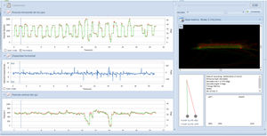 Screenshot of the clinical eye tracker software depicting eye movements during the test. The image on the right shows the representation of the screen observed by the children with the two red dots flashing, simulating the NSUCO test. On the left, graphs are plotted based on eye X position (right eye represented in red, left eye in green), fixation stability, and eye Y position.