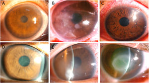 Common manifestations of acanthamoeba keratitis. Elevated superficial punctate keratitis (A). Multiple dot stromal infiltrates (B). Radial perineuritis (C). Pseudodendrite (D). Local deep infiltrates with diffuse stromal edema (E). A ring infiltrate (F).