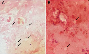 Acanthamoeba double-walled cysts in corneal scraping smears (Gram’s stain). (A) and (B) Multiple round double-walled cysts (black arrows) surrounded by neutrophils (400x).