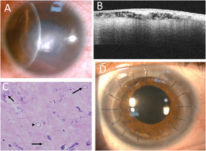 Decreased ring infiltrates with central whitish infiltrates (A). AS-OCT showing numerous hyperreflective dots or lines within the hyporeflective superficial stroma, with some acoustic shadows (B). Histopathology revealing numerous double-walled cysts (arrows) and some trophozoites (arrowhead) (Hematoxylin and eosin stain, 400x) (C). A clear corneal graft after therapeutic keratoplasty (D).