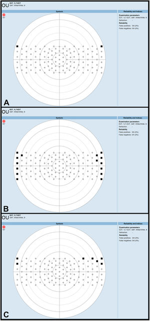European Driving Test printouts of a study participant carried out with spectacle A (thin frames and temples), spectacle B (medium-thickness frames and thick temples), and spectacle C (thick frames and medium-thickness temples). The black squares indicate missed peripheral test points. Spectacle B and C both cause three missed test points in the best 120° x 40° visual field, which must be preserved according to the European visual field requirements for driving.