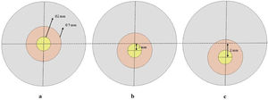 Size and location of the corneal weak spots considered: a) Central with 2 mm diameter, b) 1mm Inferior, c) 2 mm Inferior. Gray indicates the area with a normal stiffness value, red the transition zone, and yellow the keratoconus zone.