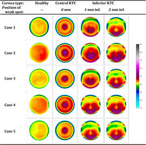 Anterior tangential curvature maps (in dioptre) for all cases (KTC: keratoconus).
