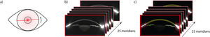 Schematic representation of the Scheimpflug image acquisition and processing. a) The Pentacam HR captures Scheimpflug images along 25 meridians of the anterior segment. b) Example of raw Scheimpflug images. c) Automated segmentation of ocular structures including the cornea (yellow), iris (green), and lateral brightness artifacts (red).
