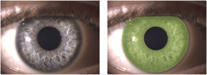Example of iris segmentation. Original slit-lamp image (left) and the corresponding segmented region (right), shown as a green transparent overlay. Segmentation was performed using the graph cut algorithm implemented in MATLAB