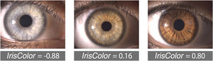 Representative examples of eyes with light, intermediate, and dark iris pigmentation, illustrating differences in the IrisColor coefficient. The numbers indicate the corresponding IrisColor values, with lower (negative) values representing lighter irises and higher (positive) values representing darker irises.