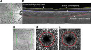 (A) Representative infrared image showing six-line radial OCT scan centered on the fovea (green); (B) segmentation using automated software; (C) representative infrared image of the OCTA scan protocol; (D) superficial vascular complex; (E) deep vascular complex; red circles indicate the central 2 mm diameter used for analysis.