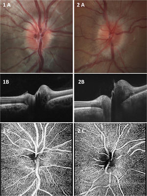 Pseudopapilledema (occult optic disc drusen) (1): 20° Color retinography.(1A); OCT-HD Edi (1 B); ONH Angiography 4.5 × 4.5 mm, Angioplex RPC(1C). Papilledema (2): 20° Color retinography.(2A); OCT-HD Edi (2 B); ONH Angiography 4.5 × 4.5 mm, Angioplex RPC(2C).