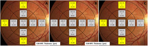 Macular retinal thickness in myopic (A), emmetropic (B), and hyperopic (C) eyes. The post-hoc statistical significance between the three refractive groups is shown in yellow (p < 0.050).