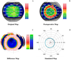 Strategy to determine the TZD and TZA. A. Baseline original tangential curvature map; B. Postoperative tangential curvature map at the twelve-month visit; C. Difference tangential curvature map; D. Simulated difference map by R; the black triangle represents the pupil center, the blue ring indicates the fitted treatment zone, and the red circle indicates the center of the fitted treatment zone. The distance between the black triangle and red circle is defined as the TZD. The area of the blue ring is defined as the TZA. TZA: treatment zone area; TZD: treatment zone decentration; R: software for statistics and plotting, version 4.2.2, http://www.R-project.org/.