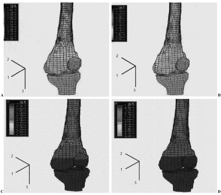 Simulaci n En 3D Con Elementos Finitos De Un Modelo De Pr tesis De Simulaci n En 3D Con Elementos Finitos De Un Modelo De Pr tesis De