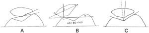 Esquema de mediciones. A: ángulo patelofemoral lateral de Laurin. B: desviación lateral de Sasaki y Yagi. C: ángulo de congruencia de Merchant.