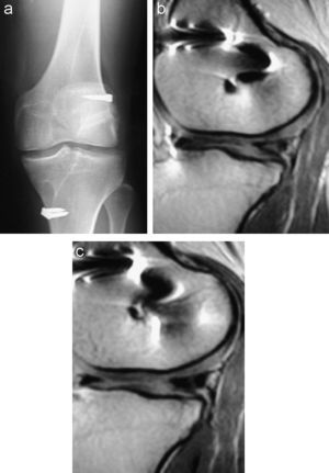 Implantes meniscales de colágeno (CMI) con buena evolución clínica y de imagen a los 2 años. a: radiografía en carga. b y c: resonancia magnética con imagen de CMI, que conserva el espacio articular.