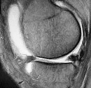 Resonancia magnética de un implante meniscal con año y medio de evolución.