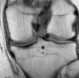 Imagen de resonancia magnética del implante, como seudomenisco, al año de la intervención.