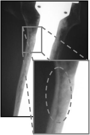 Línea de radiotransparencia en la interfaz cemento-hueso e imagen ampliada en un caso de hemiartroplastia de hombro.