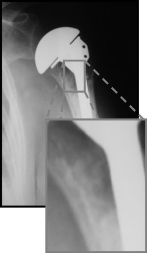 Línea de radiotransparencia en la interfaz implante-cemento e imagen ampliada en otro caso de hemiartroplastia de hombro.