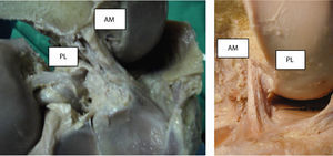 Visión medial del ligamento cruzado anterior tras extirpar el cóndilo femoral interno donde se aprecia la clara diferenciación de los dos fascículos: anteromedial (AM) y posterolateral (PL).