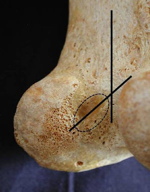 Área de inserción femoral del ligamento cruzado anterior e inclinación respecto a la cortical posterior; se aprecia su disposición ovalada o en semicírculo.