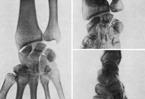 Seudoartrosis de escafoides. Resultado a los tres meses de la intervención (estiloidectomía radial e implantación de injerto óseo autólogo extraído de la extremedidad distal del radio).