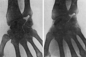 Seudoartrosis de escafoides. Resultado a los cinco meses de la intervención (estiloidectomía radial y ostesíntesis mediante tornillo).