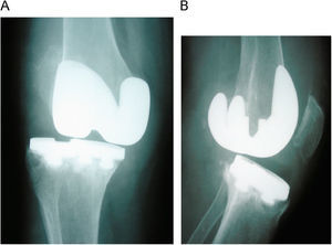 Radiografías de una prótesis total de rodilla inestable por insuficiencia ligamentosa. A: proyección anteroposterior. B: proyección lateral.