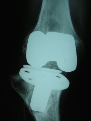 Radiografía anteroposterior de una prótesis de rodilla inestable por aflojamiento de su componente tibial.