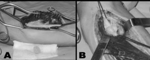Fotografía intraoperatoria. A: muestra schwannoma de nervio mediano disecado en el tercio medio del antebrazo. B: 2 schwannomas en el nervio mediano en la cara anterior del codo.